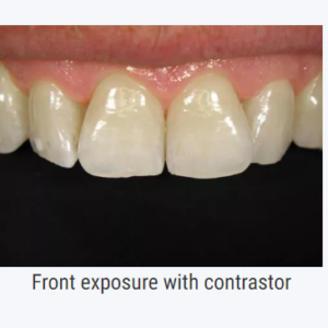 dentaleyepad kontrastor front billede